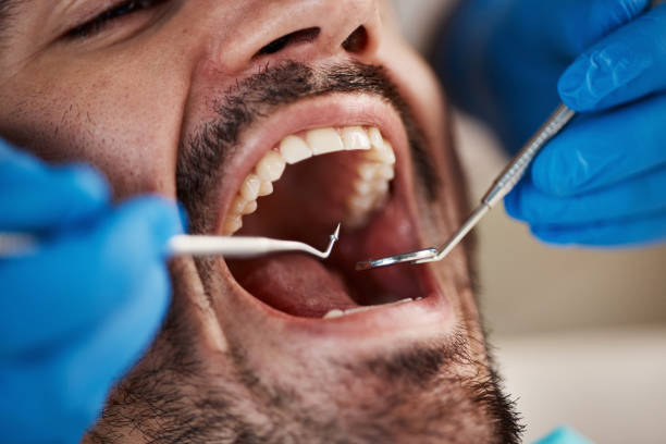 Best Urgent Care for Lost Fillings or Crowns in Riverbend, WA